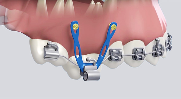 Appareils orthodontiques fixes : Orthodontie Garches - Cabinet 21 Libération